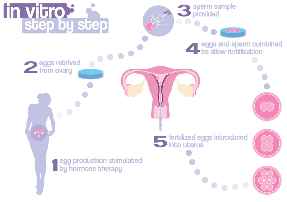 In Vitro Fertilization (IVF)