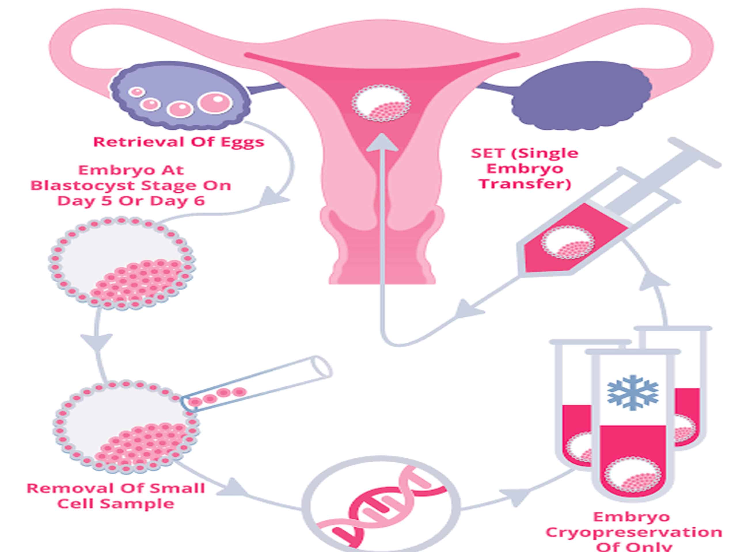 Elective Single Embryo Transfer (eSET)