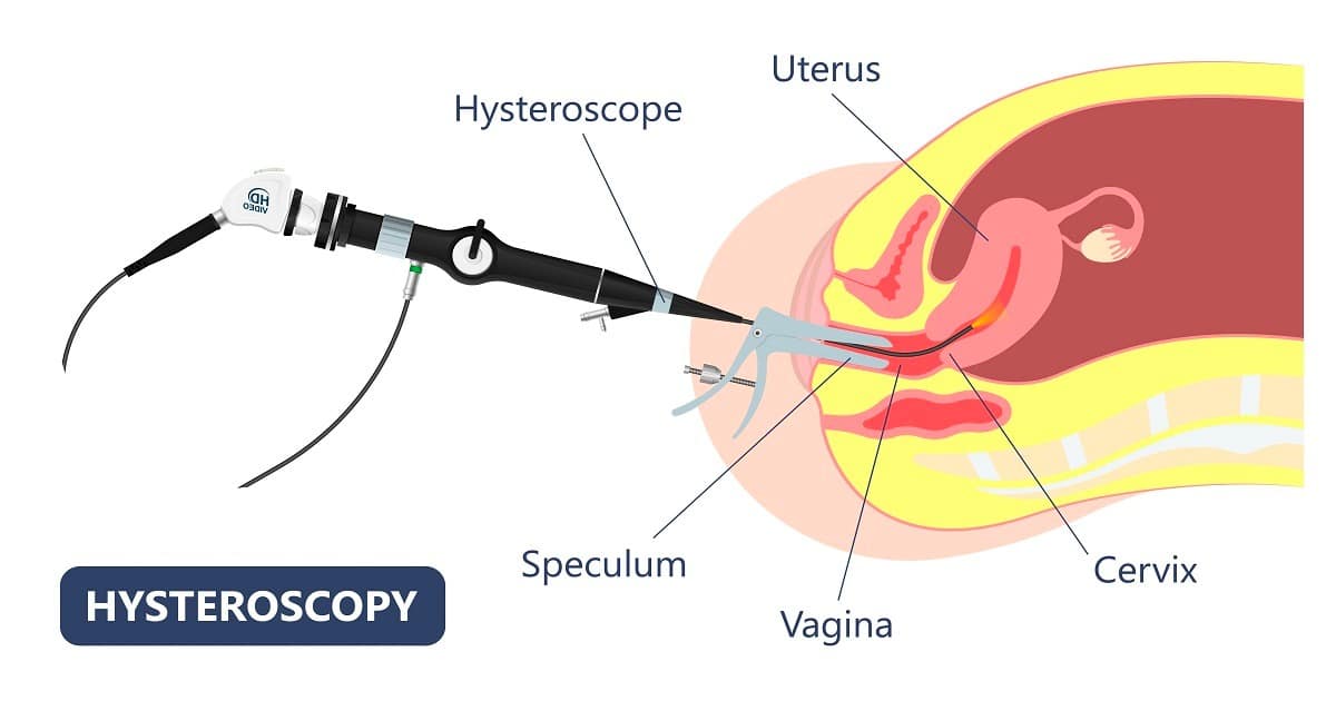 Hysteroscopy chart