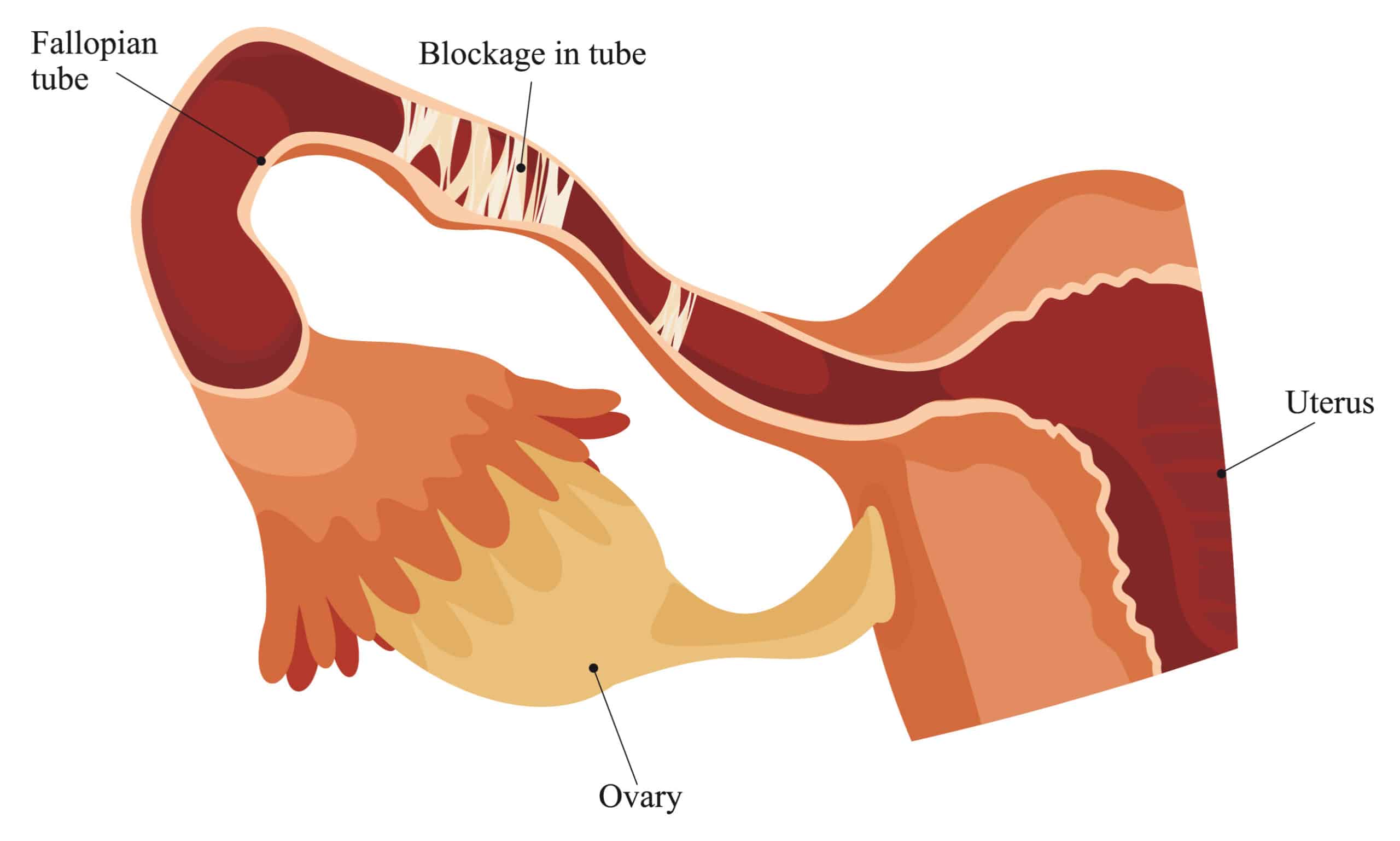 Fertility Blocked Fallopian Tube Scaled